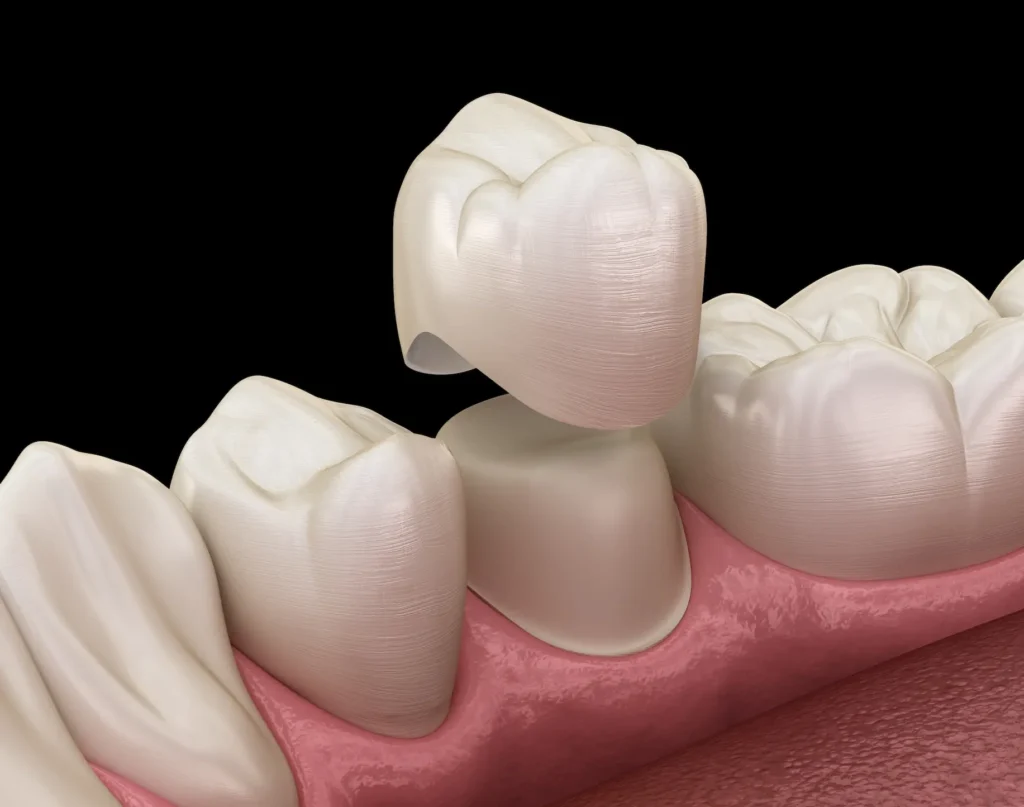 same-day dental crown