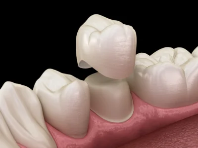 same-day dental crown