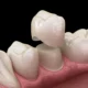 same-day dental crown
