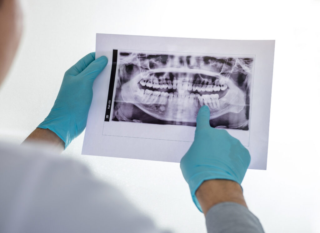 x rays dentist 