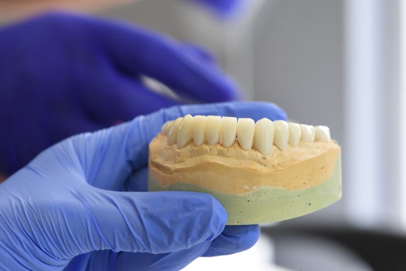 Gloved hand holding a plaster dental model fitted with a row of tooth-colored crowns