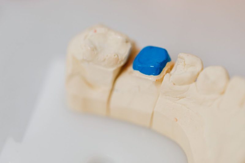 Plaster dental model of a lower back tooth row with one tooth prepared and a blue restoration placed